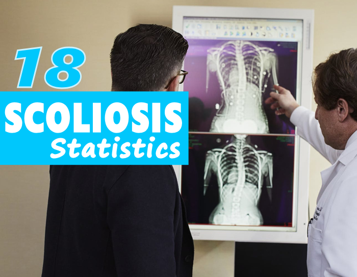 scoliosis statistics