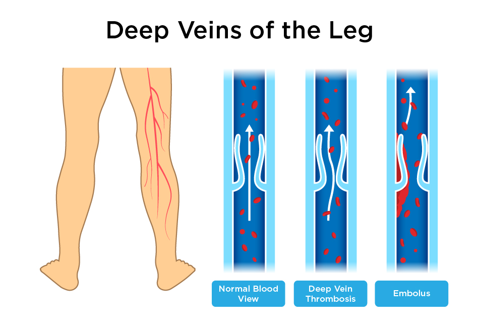 benefits of sleeping with legs elevated deep vein thrombosis