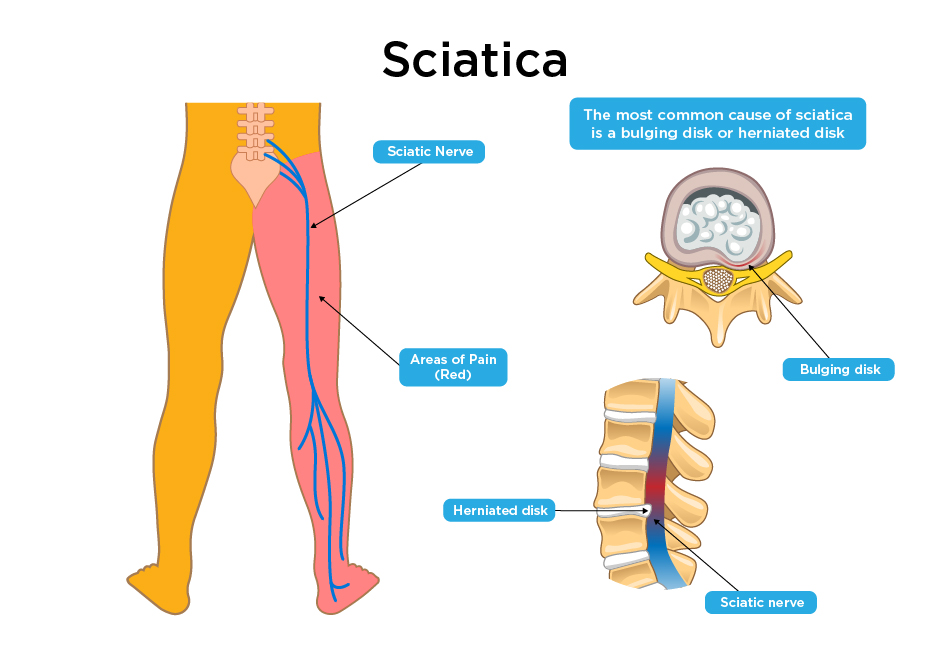 benefits of sleeping with legs elevated sciatica