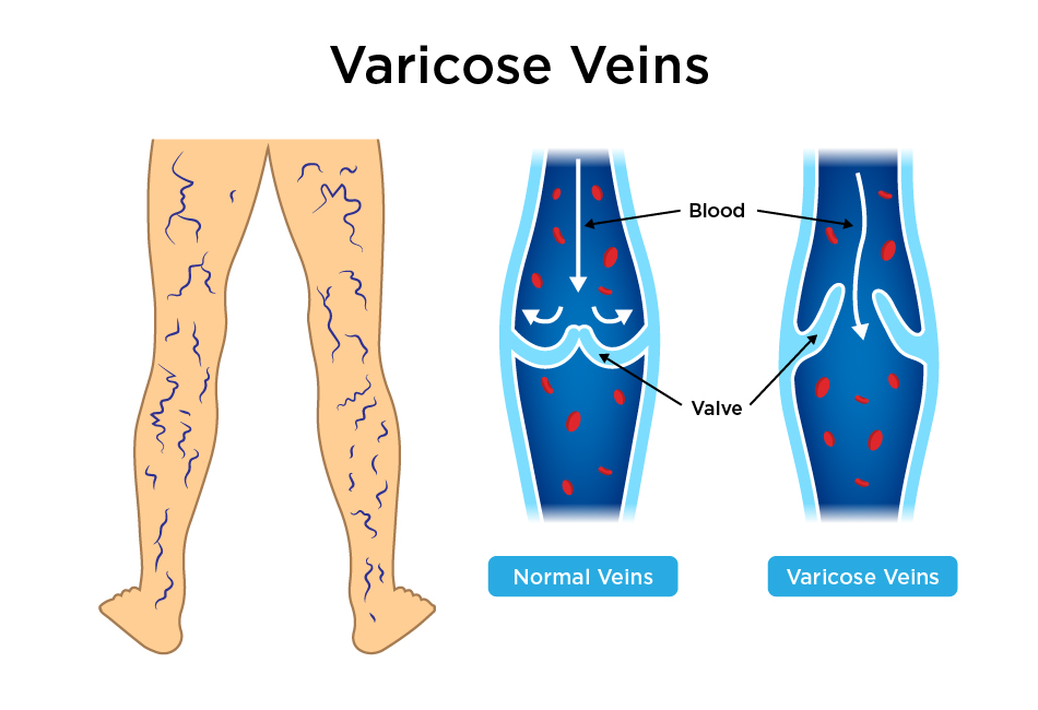 benefits of sleeping with legs elevated varicose veins